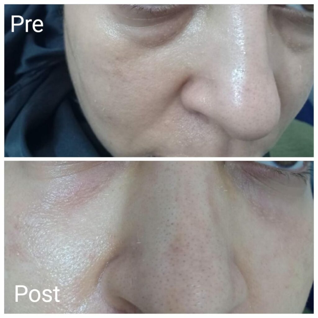 Removing the hollow under the eye